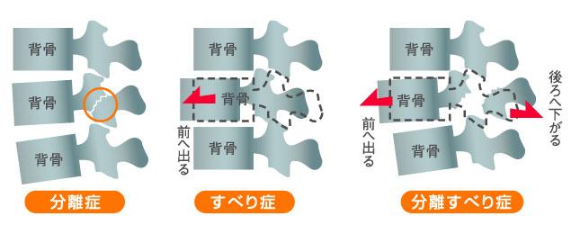 脊椎分離症 すべり症ならひたちなか市口コミno 1 いのうえ接骨院 へ