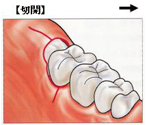 術式. 親知らず抜歯の手順