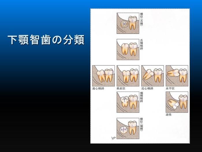 智歯の抜歯ナビゲーション 笠崎安則／著 木津英樹／著 朝波惣一郎／著 