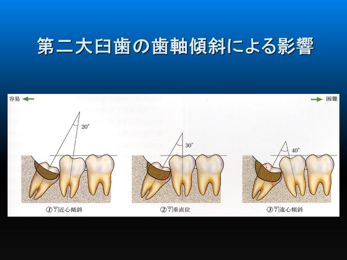 智歯の抜歯ナビゲーション - 健康/医学