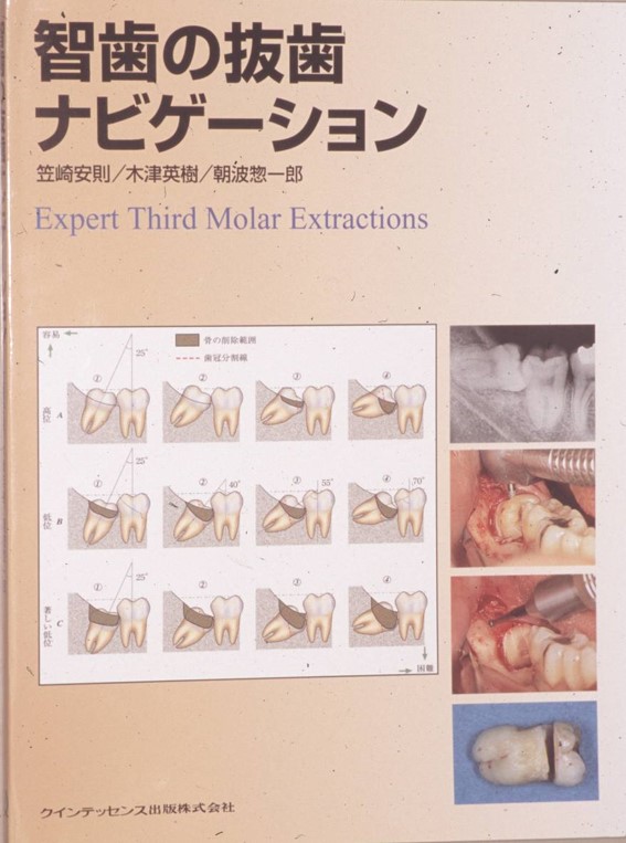 智歯の抜歯ナビゲーション - 健康/医学
