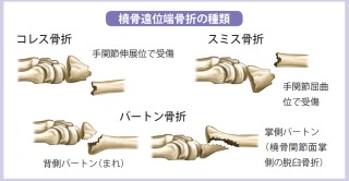 井上整骨院針灸院カイロ整体 骨折 ひび